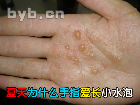 byb.cn 夏天為什么手指愛長小水泡