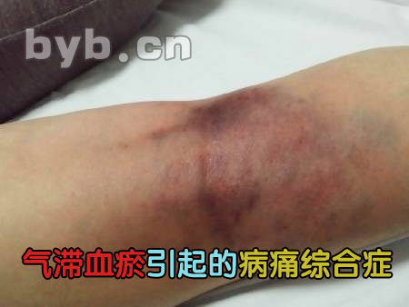 byb.cn 氣滯血瘀